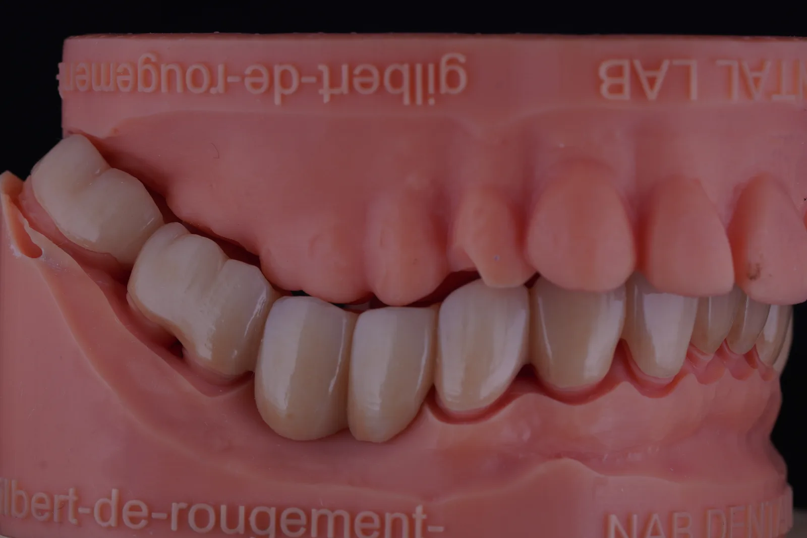 Zirconia Bridge — 16 Units photo 3