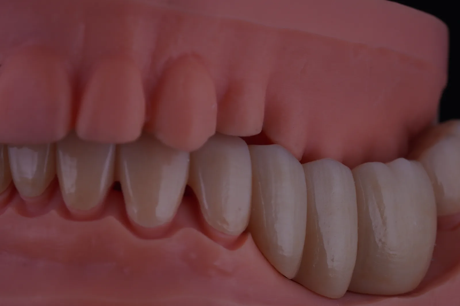 Zirconia Bridge — 16 Units photo 4