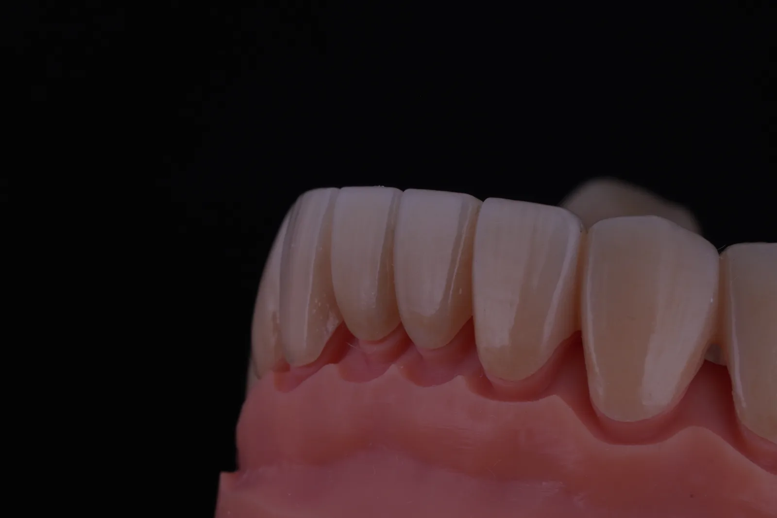 Zirconia Bridge — 16 Units photo 6
