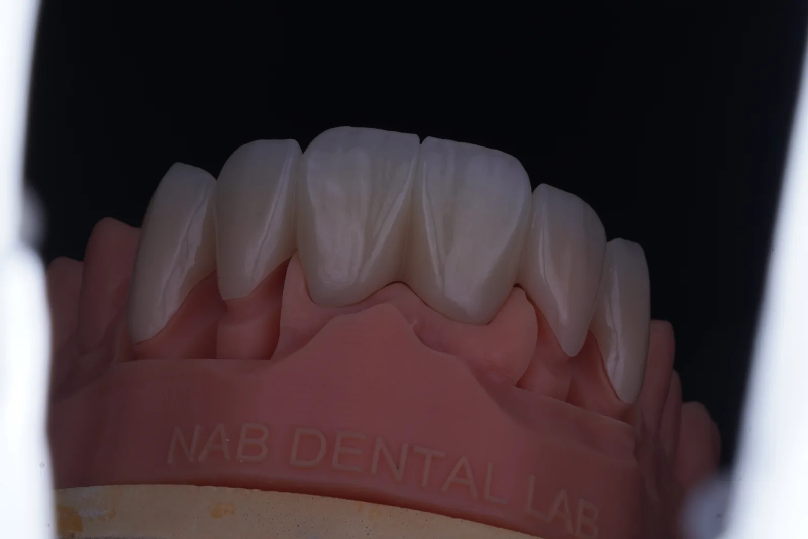 Zirconia Bridge — 6 Units photo 2