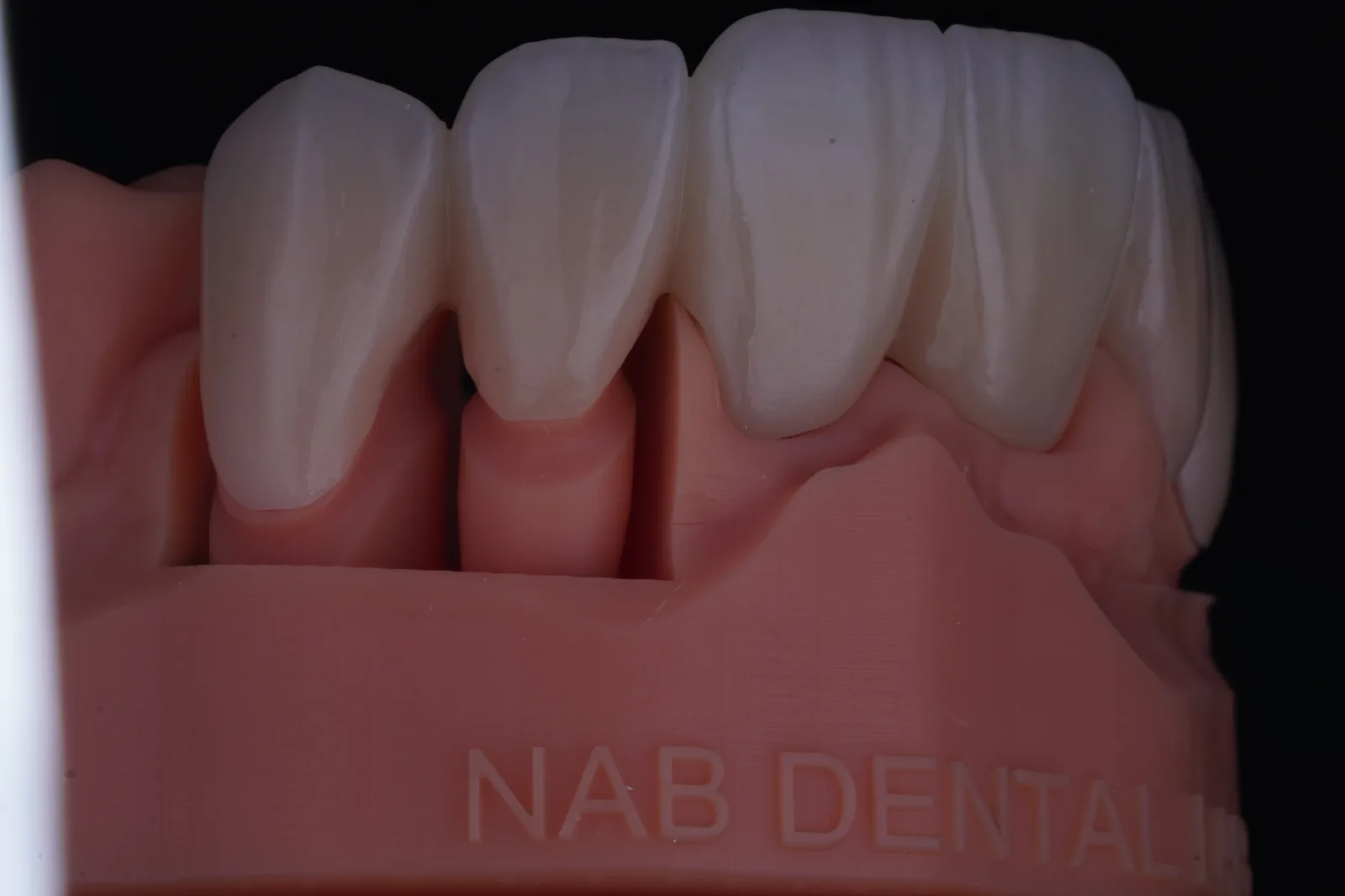 Zirconia Bridge — 6 Units photo 3
