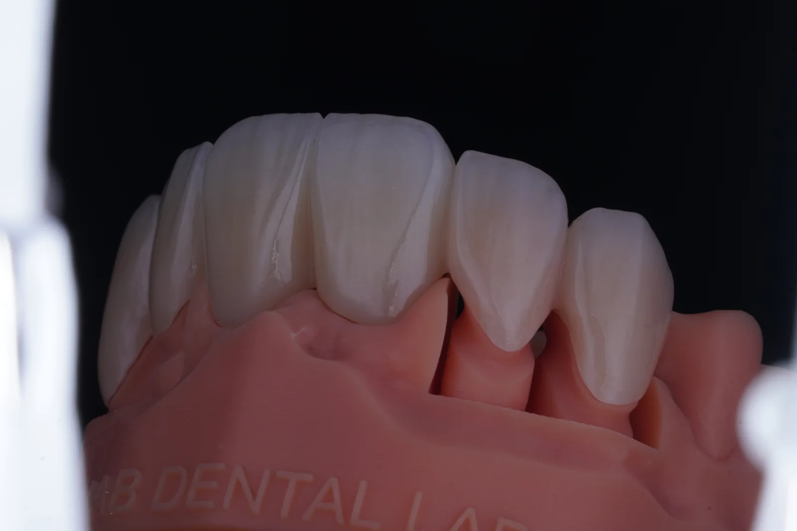 Zirconia Bridge — 6 Units photo 4