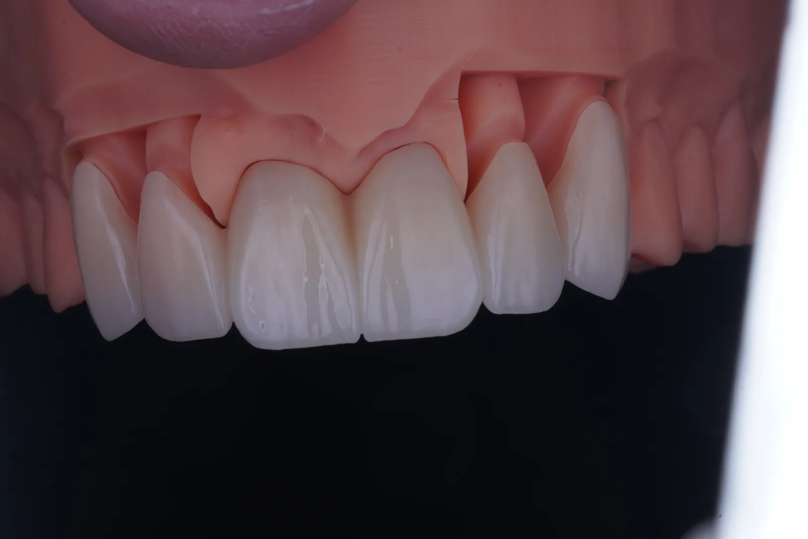 Zirconia Bridge — 6 Units photo 1