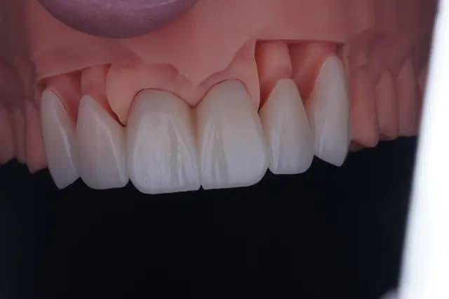 Zirconia Bridge — 6 Units