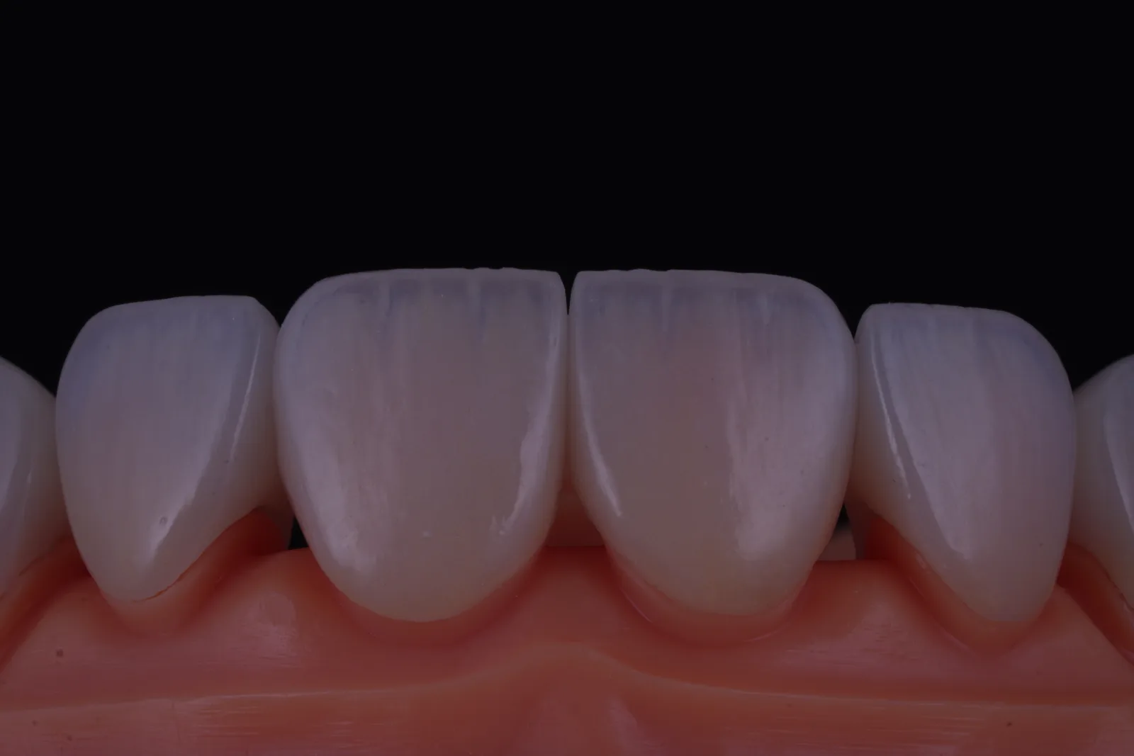 Emax Crown — Natural photo 2
