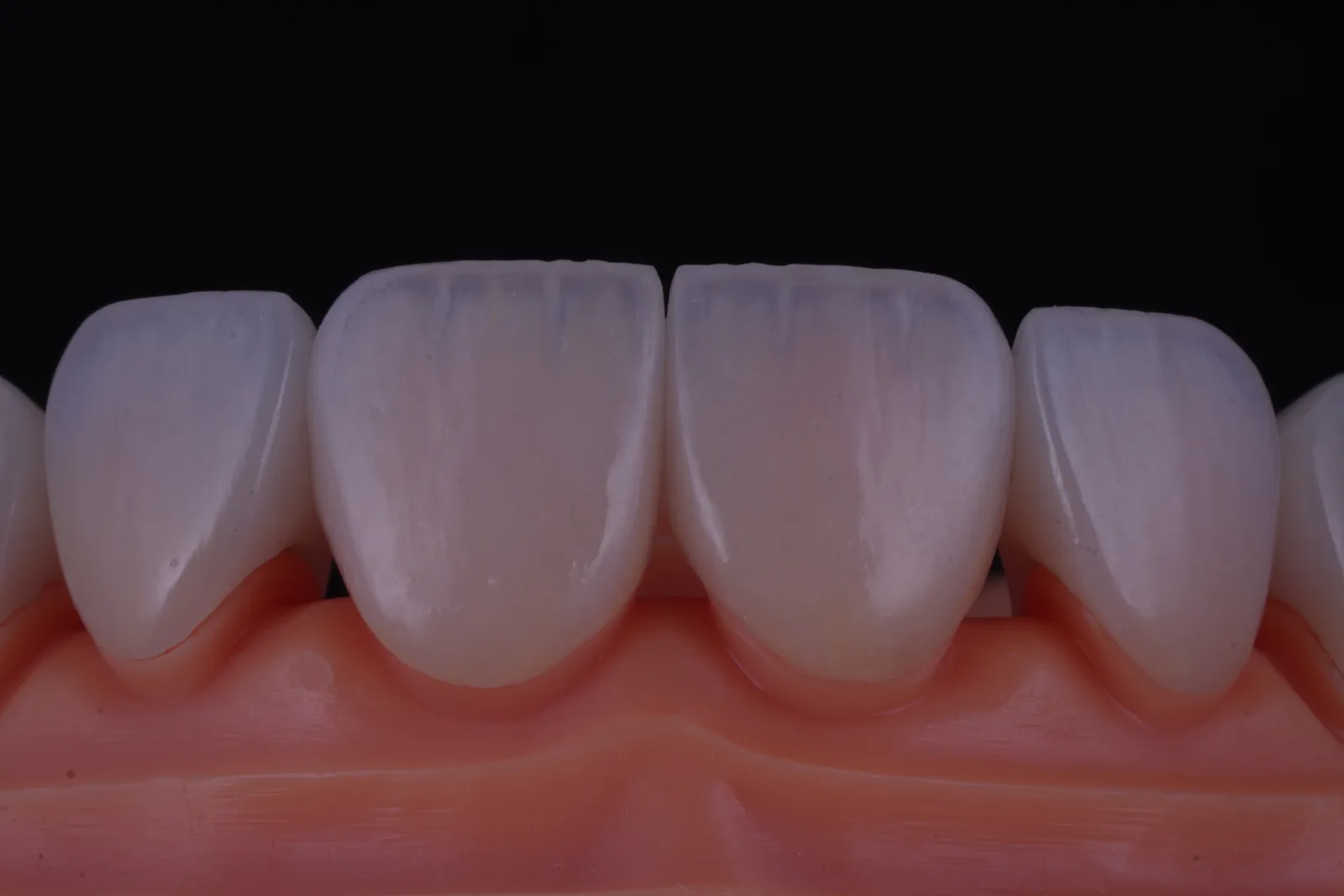 Emax Crown — Natural photo 3