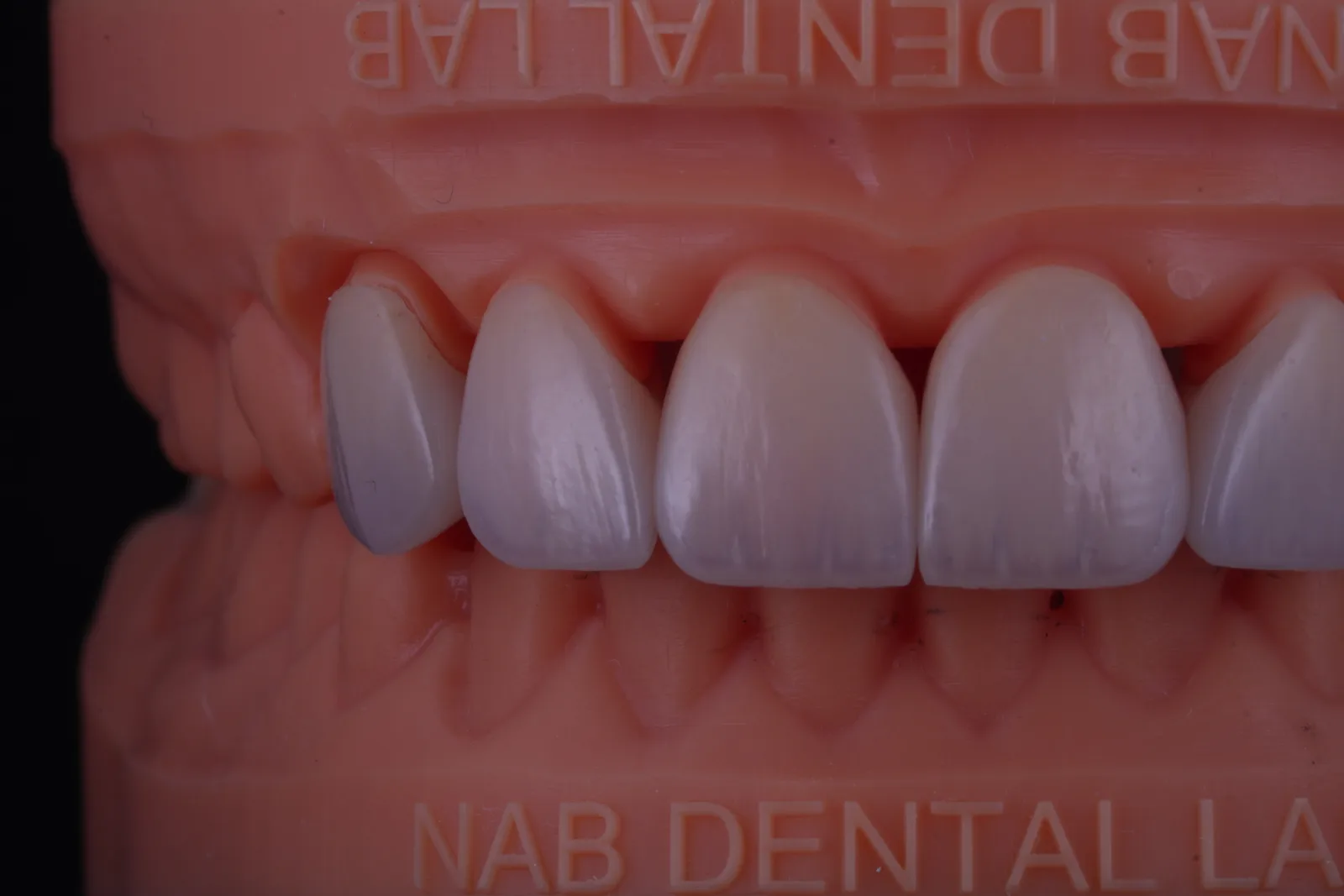 Emax Crown — Natural photo 5