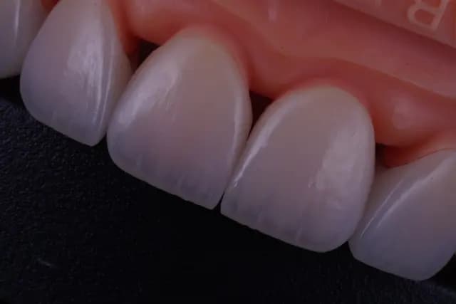Emax Crown — Natural