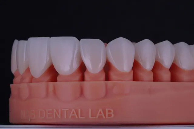 Zirconia Crown — Classic