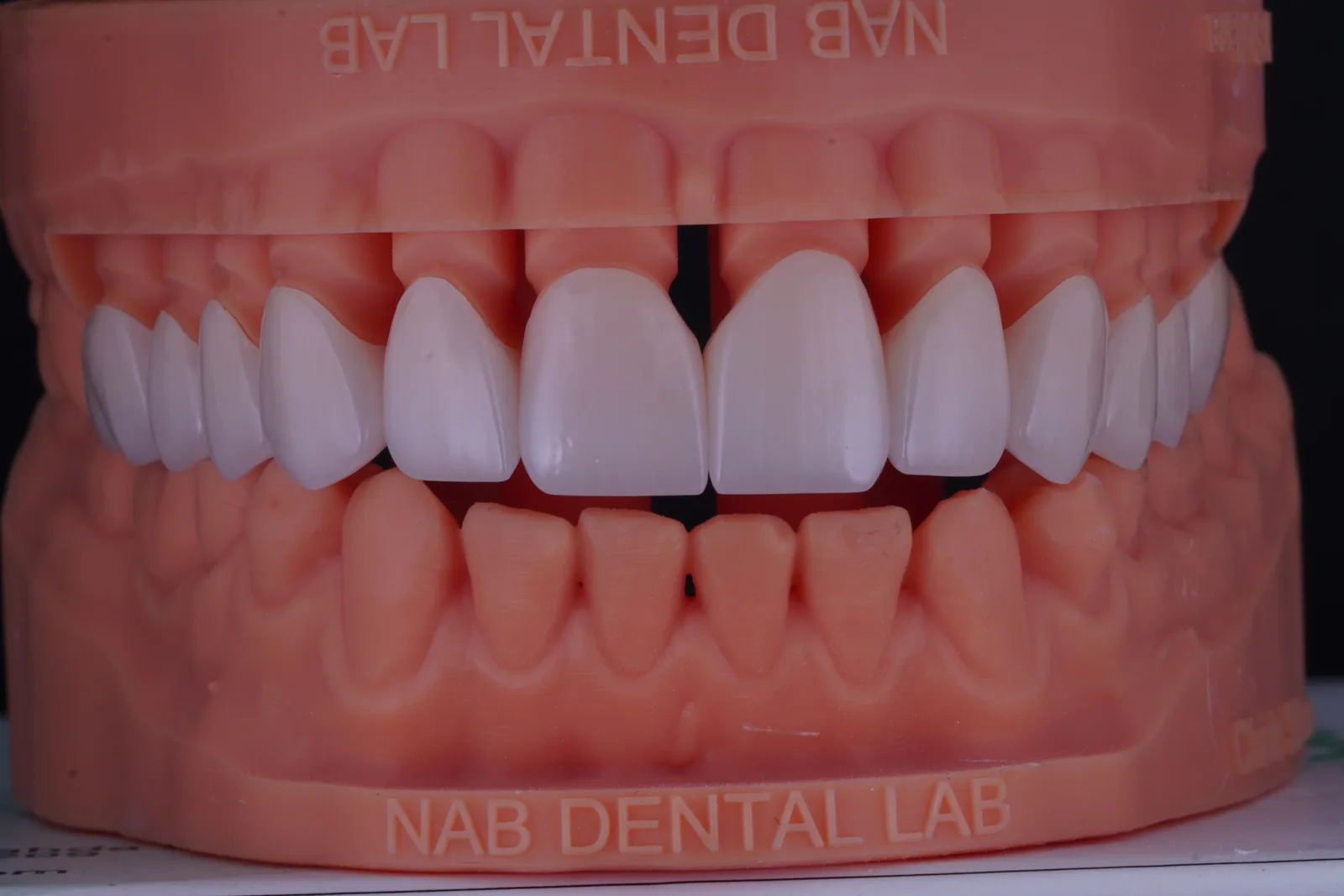 Zirconia Crown — Classic photo 4
