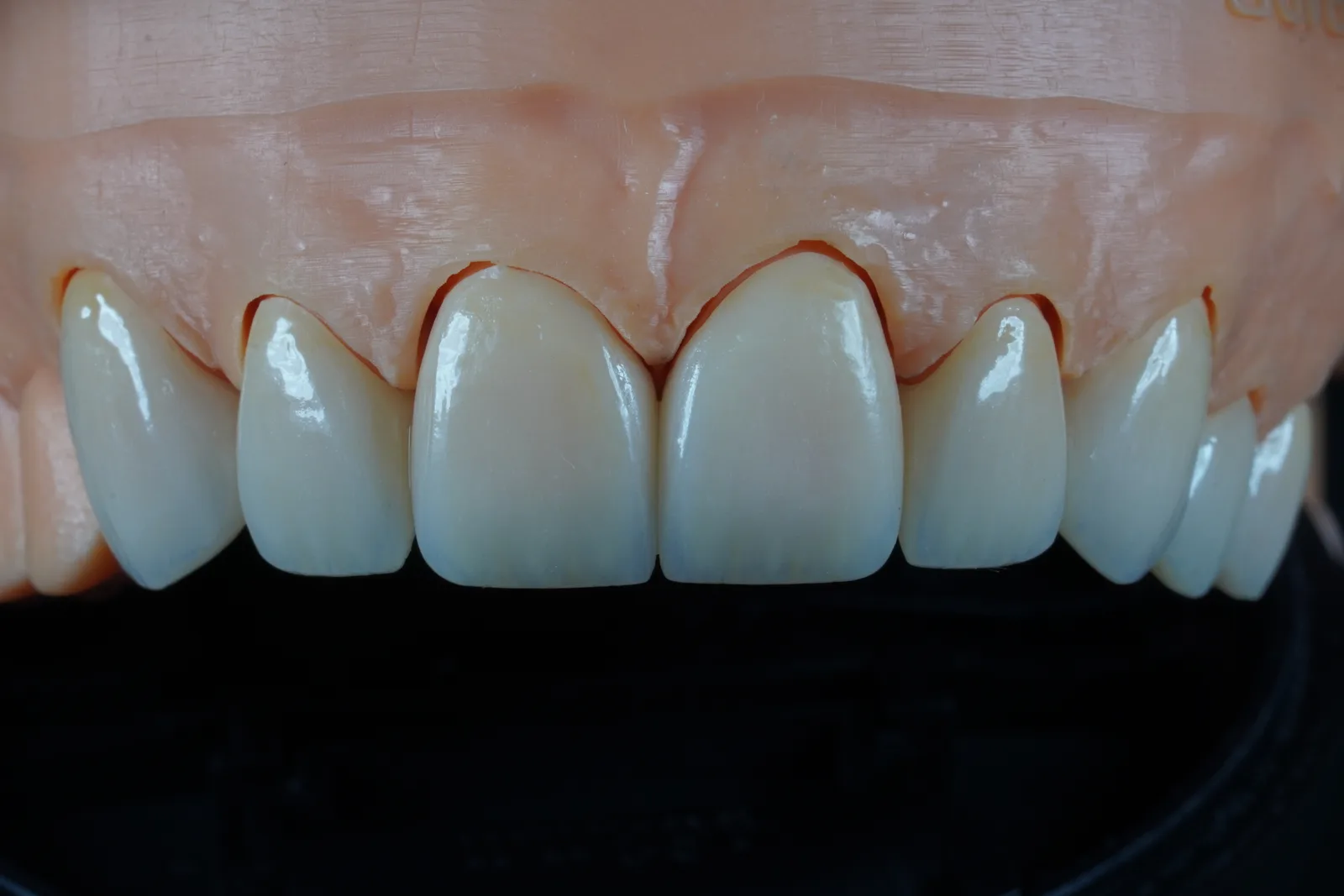 Zirconia Crown — Natural photo 1