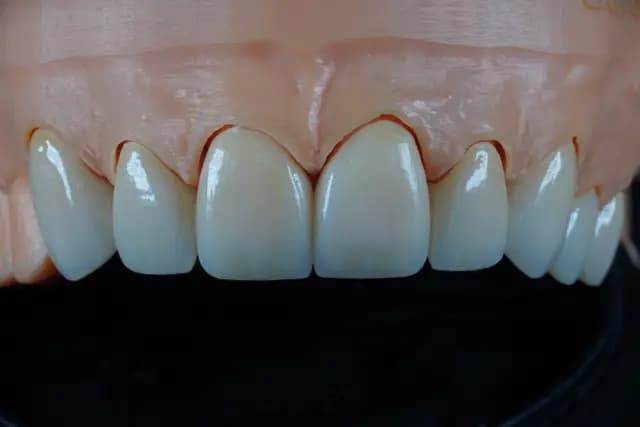 Zirconia Crown — Natural