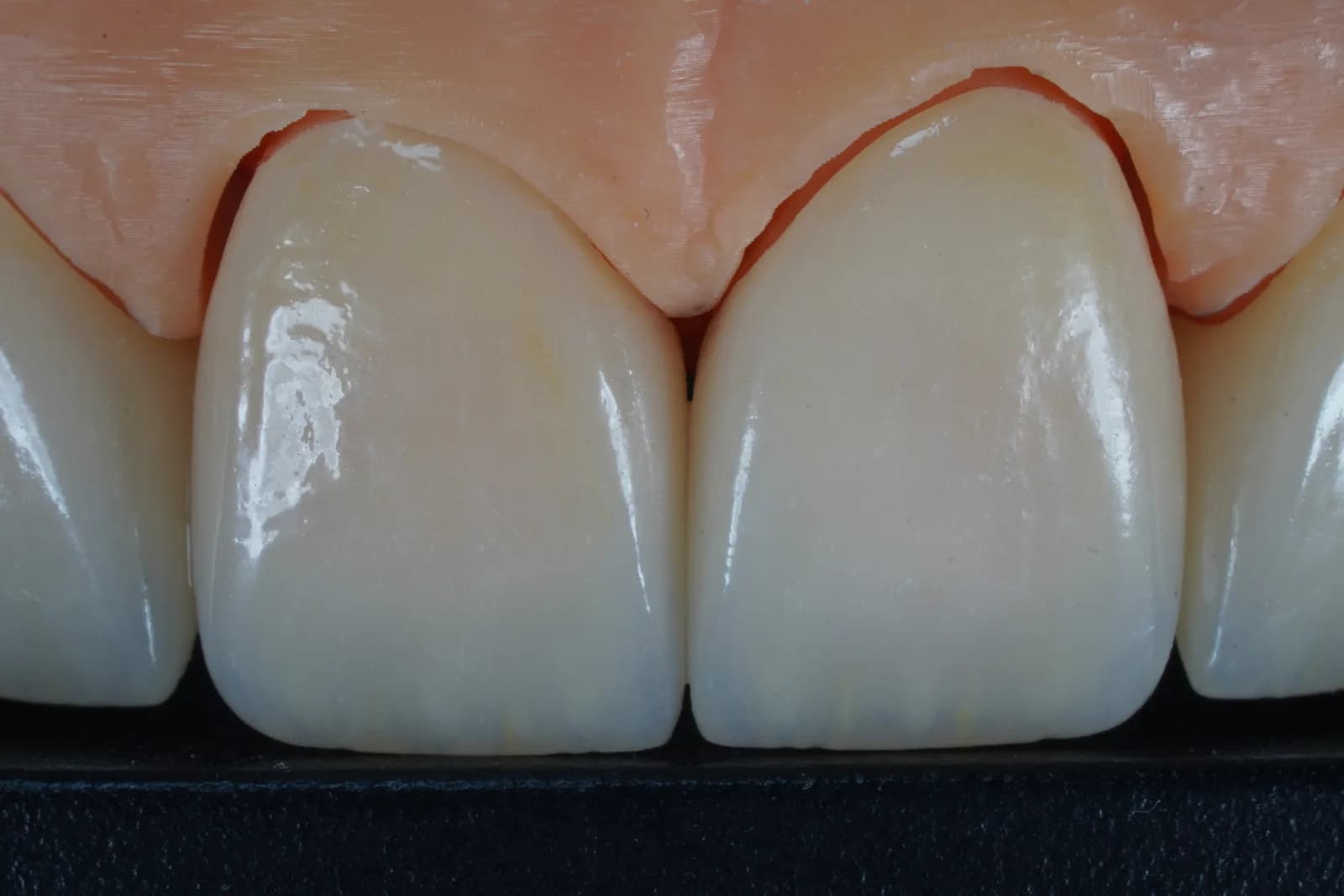 Zirconia Crown — Natural photo 2