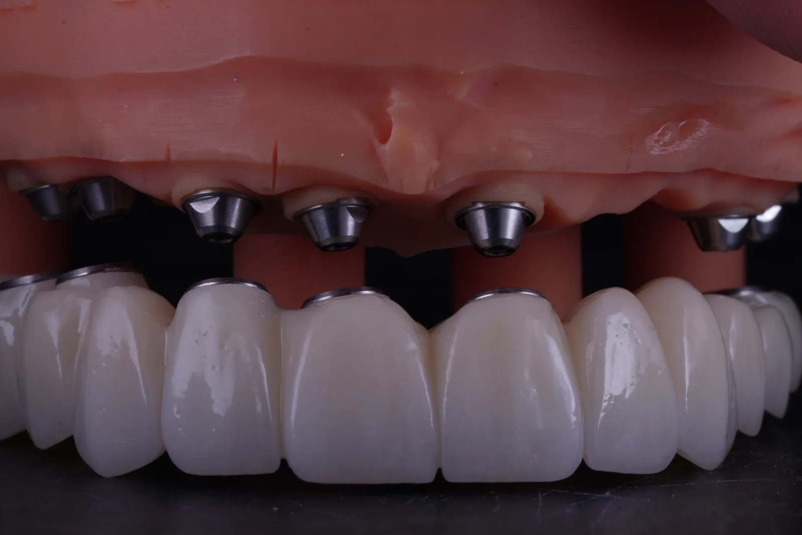 All-on-X — Full-Arch Reconstruction photo 5