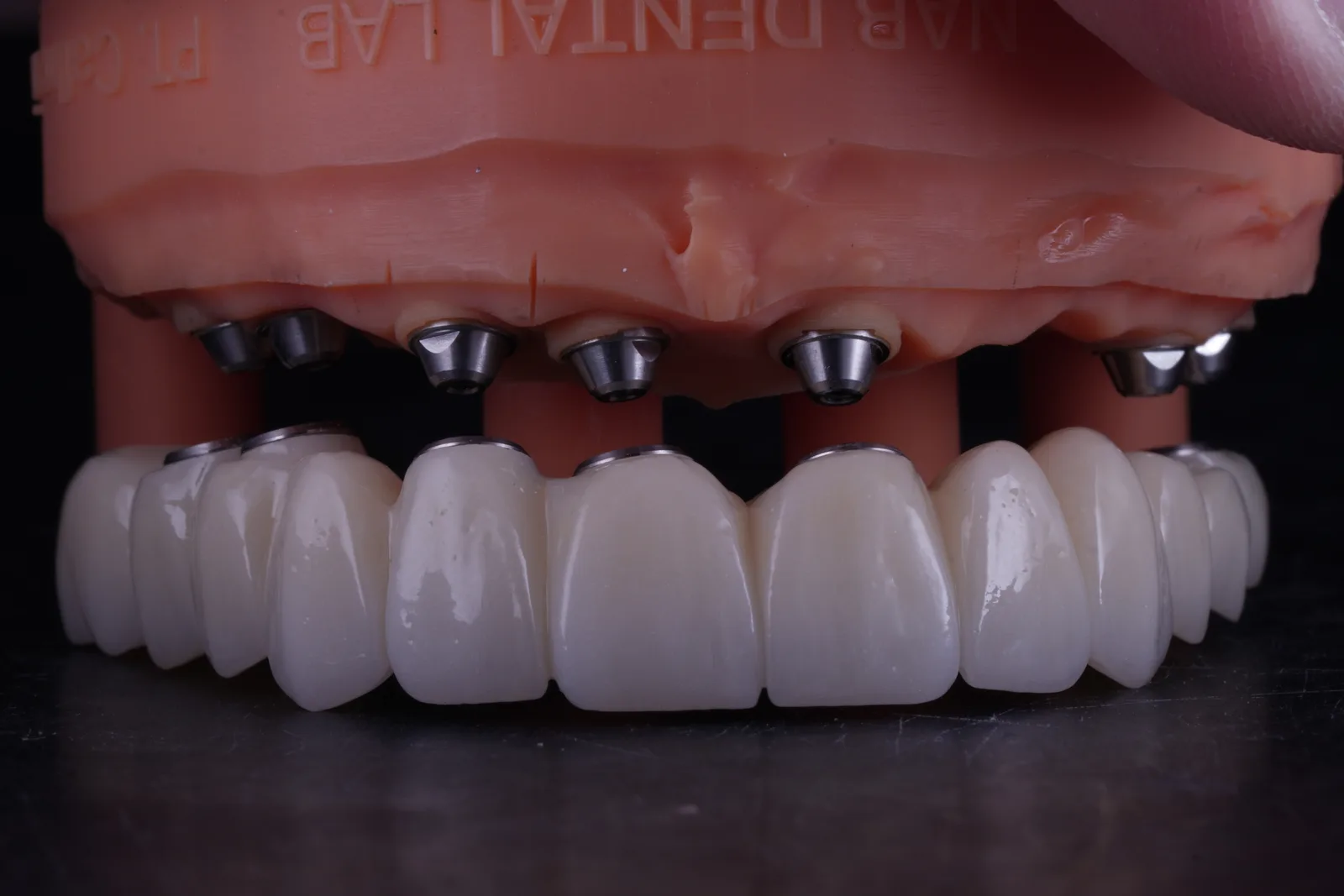 All-on-X — Full-Arch Reconstruction photo 6