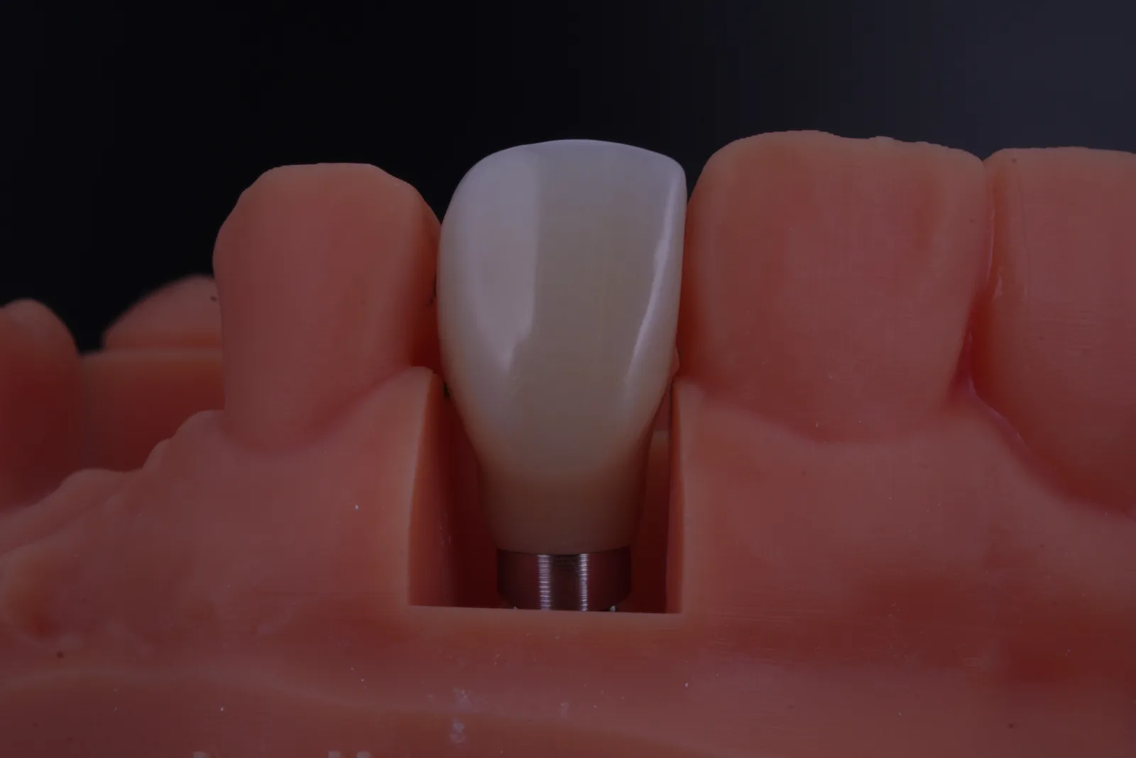 Implant Crown — Lateral photo 2