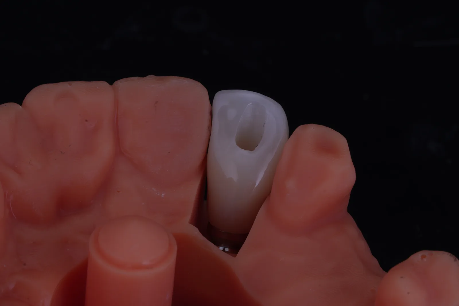 Implant Crown — Lateral photo 3