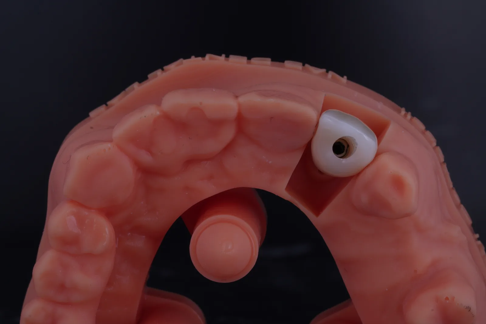 Implant Crown — Lateral photo 4