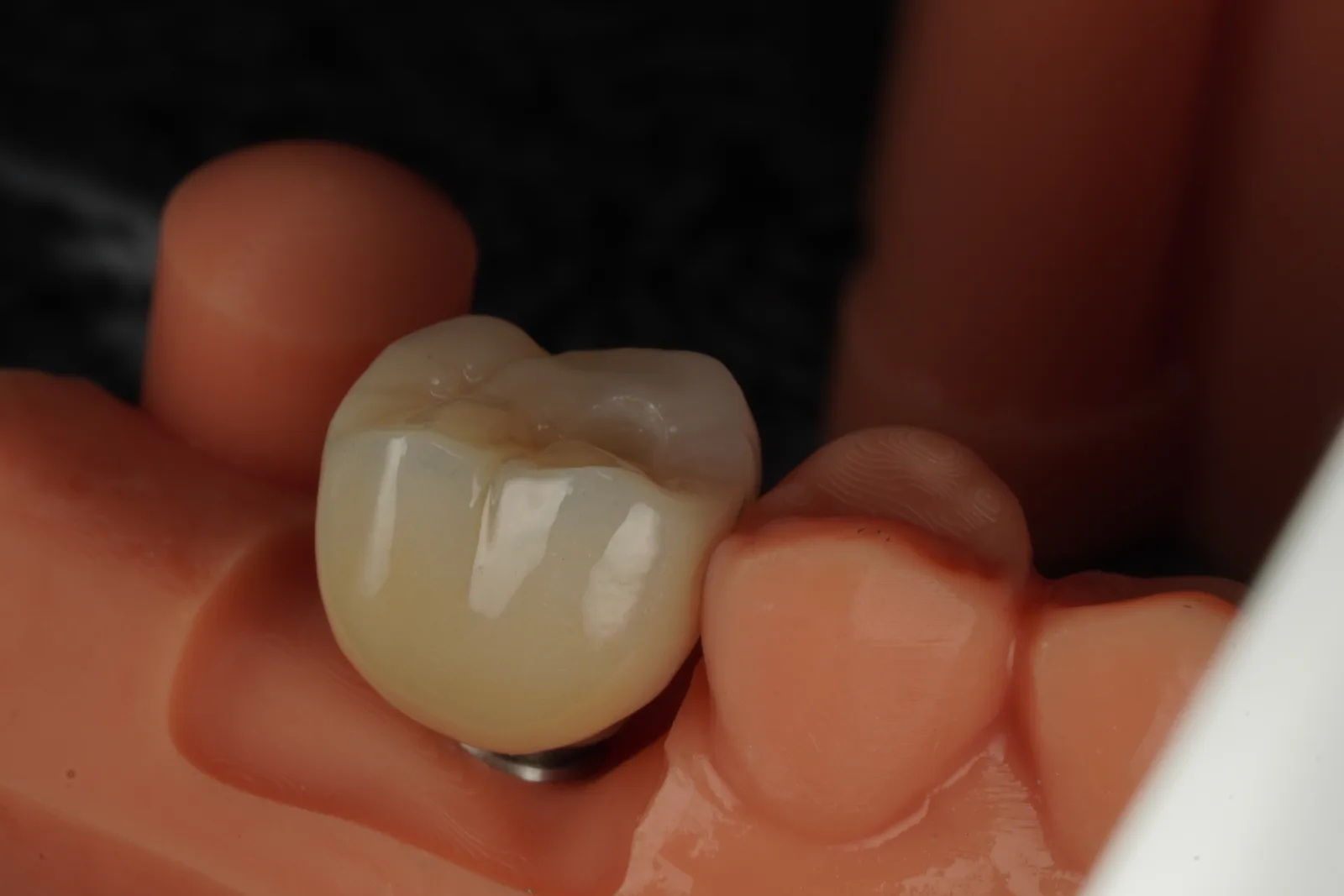 Implant Crown — Molar photo 2