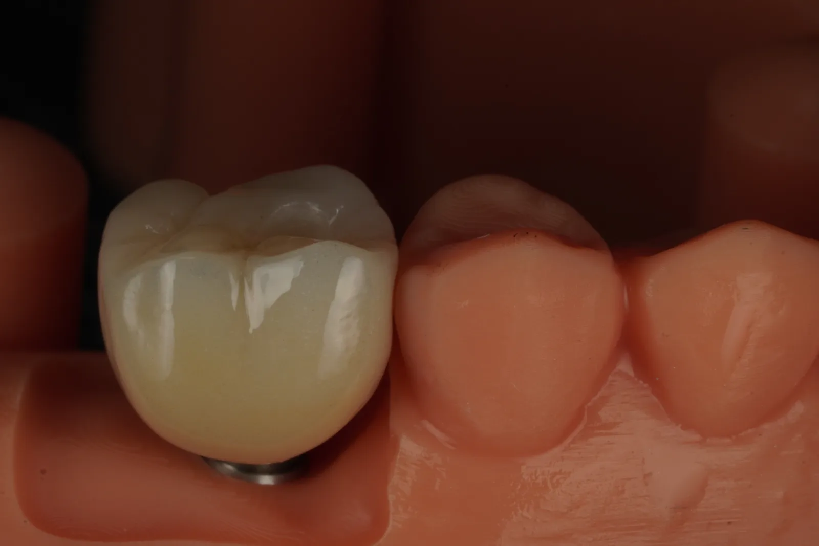 Implant Crown — Molar photo 3