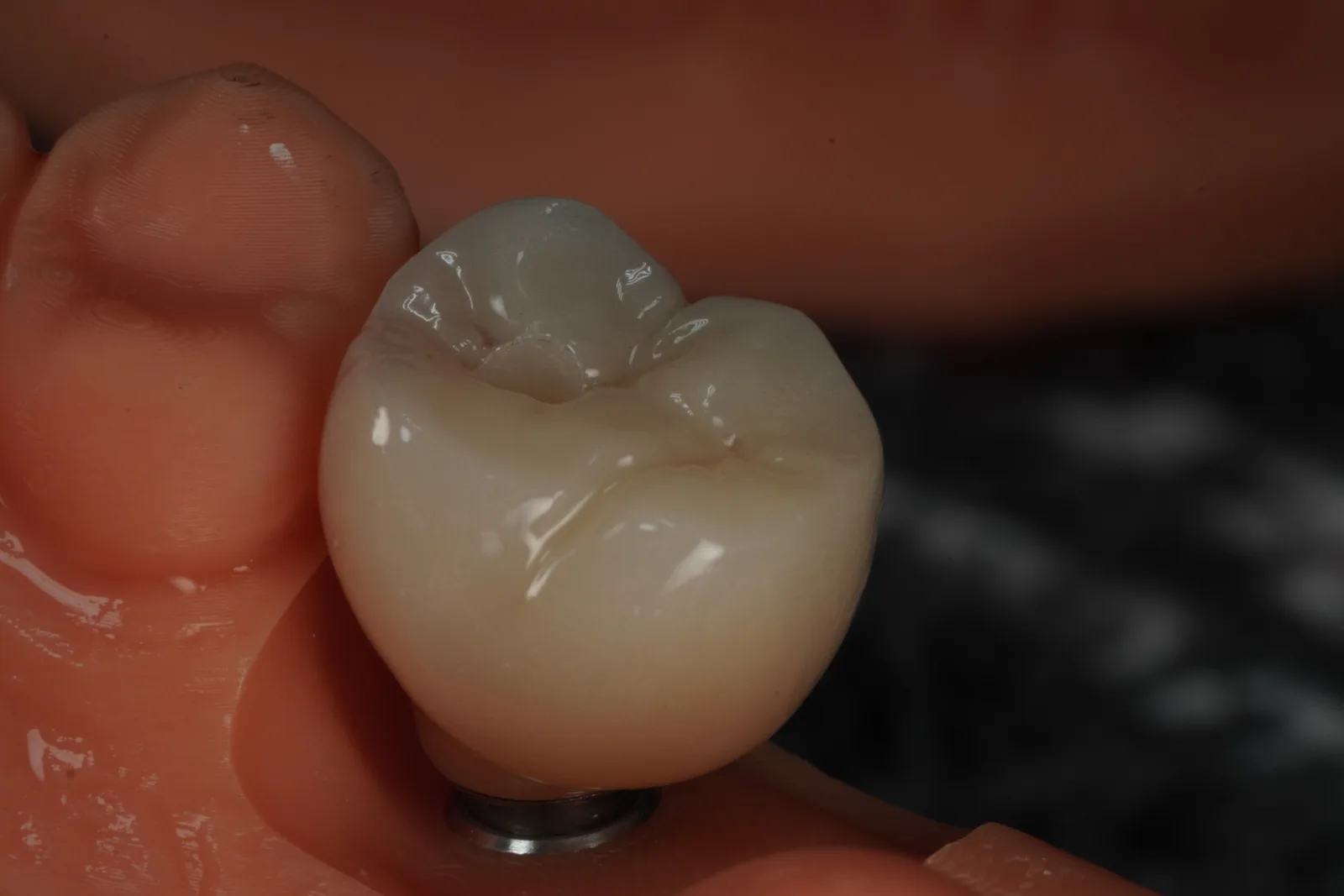 Implant Crown — Molar photo 5