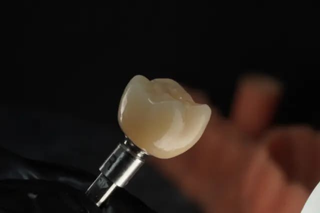Implant Crown — Molar