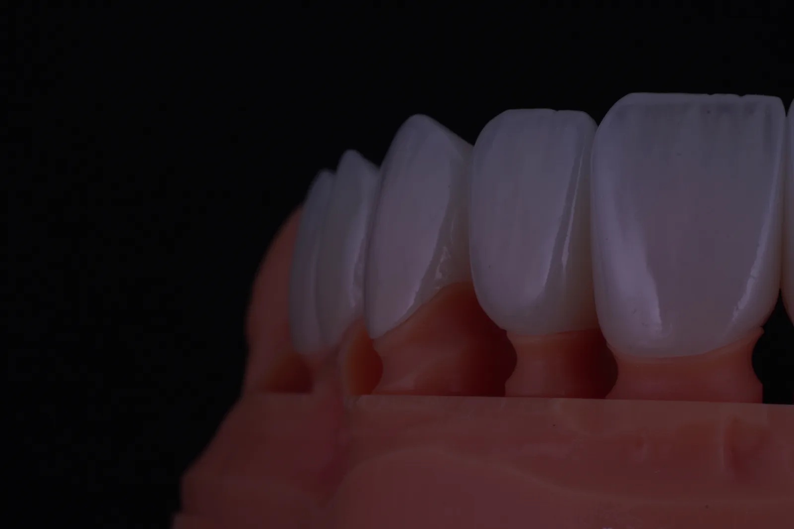 Modern Veneer — Case 1 photo 3