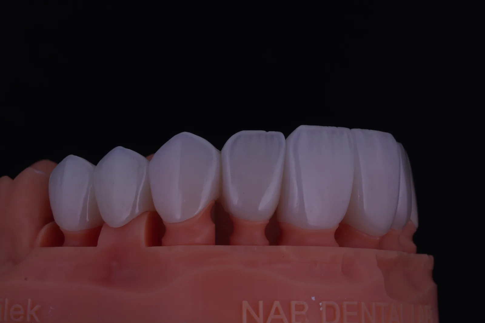 Modern Veneer — Case 1 photo 4