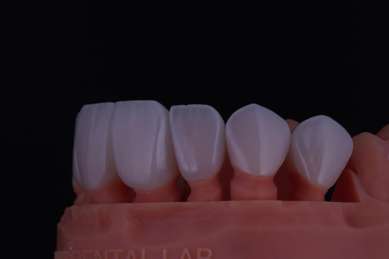 Modern Veneer — Case 1 photo 5