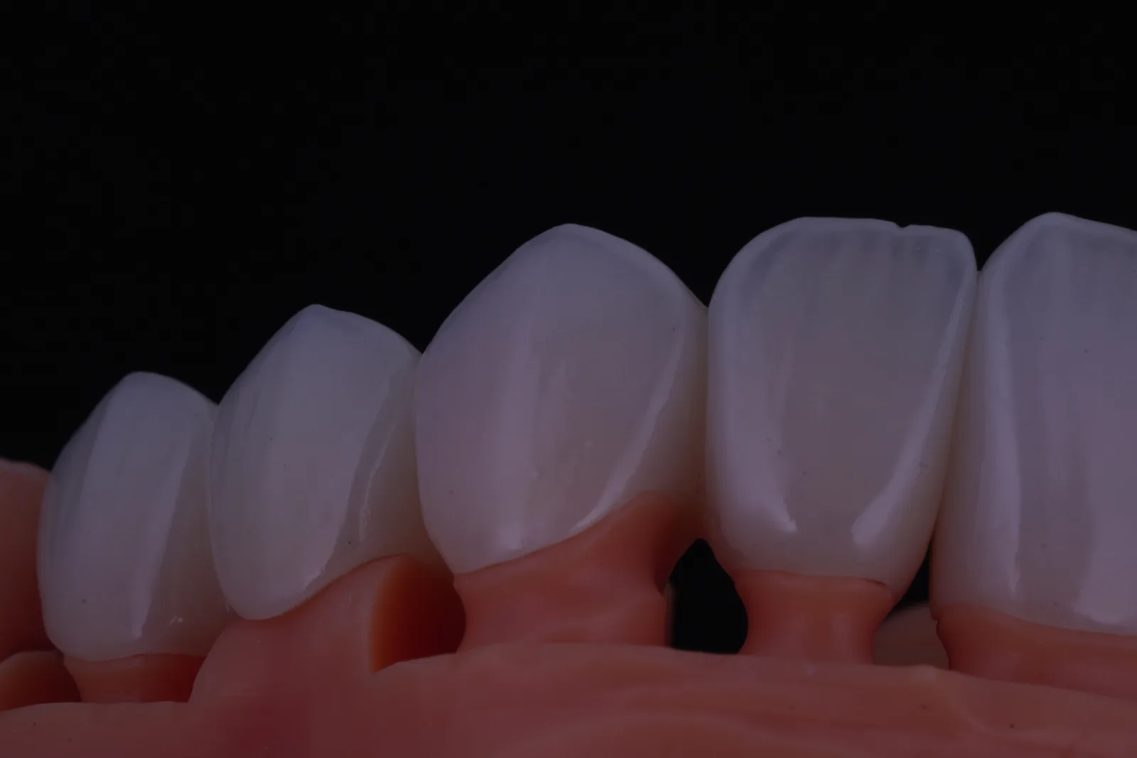 Modern Veneer — Case 1 photo 6