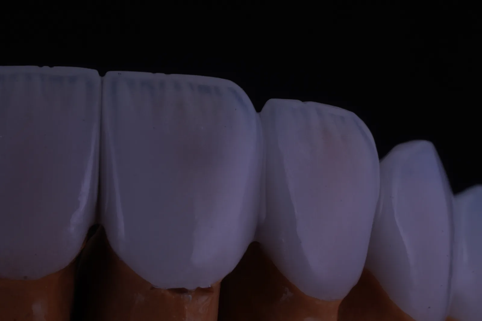 Modern Veneer — Case 2 photo 2