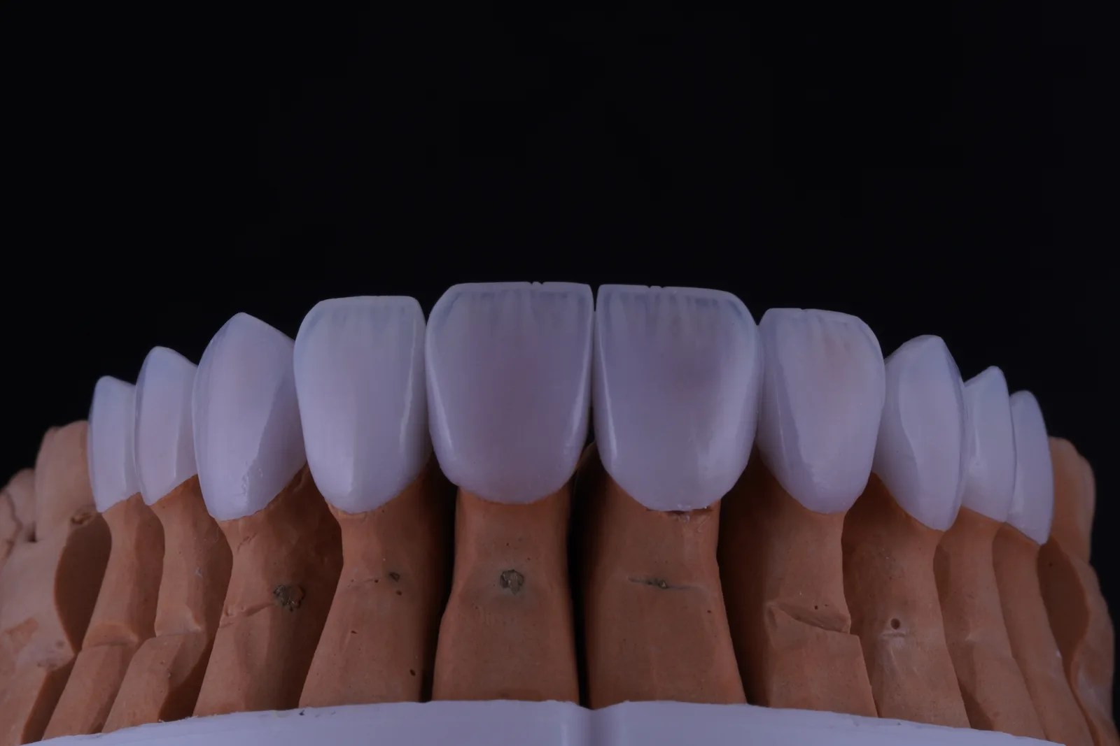 Modern Veneer — Case 2 photo 3