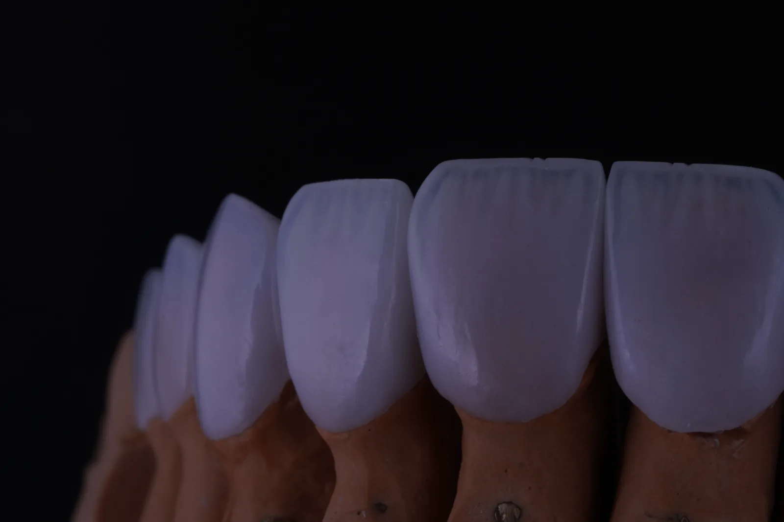 Modern Veneer — Case 2 photo 4