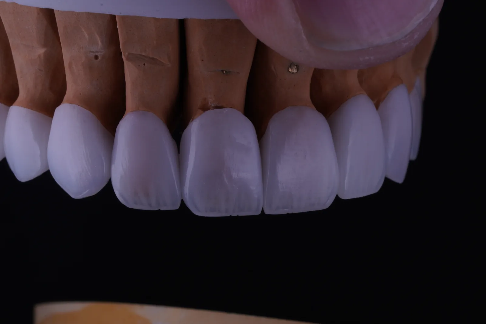 Modern Veneer — Case 2 photo 5
