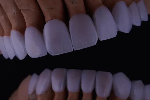 Modern Veneer — Case 2