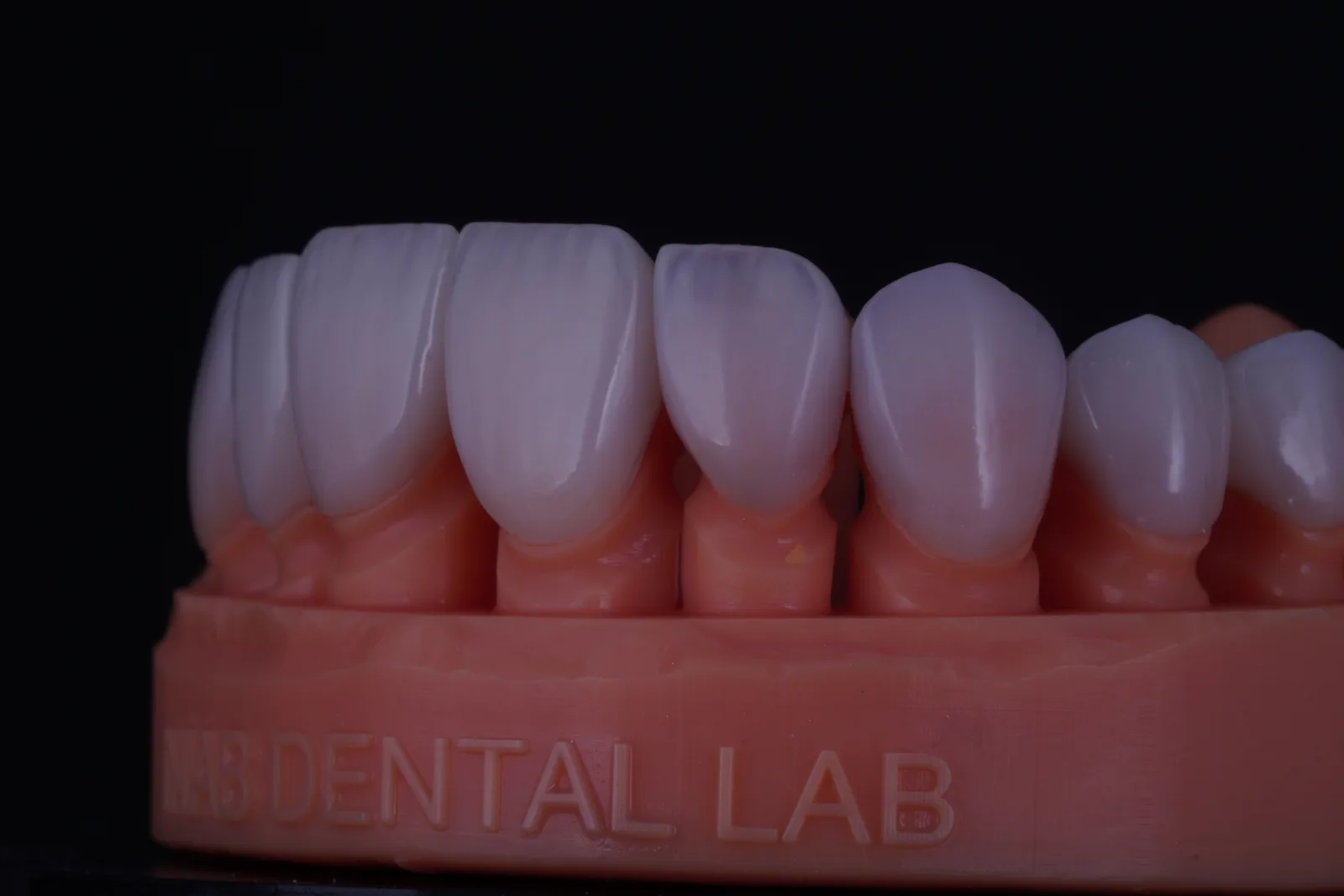 Modern Veneer — Case 3 photo 2