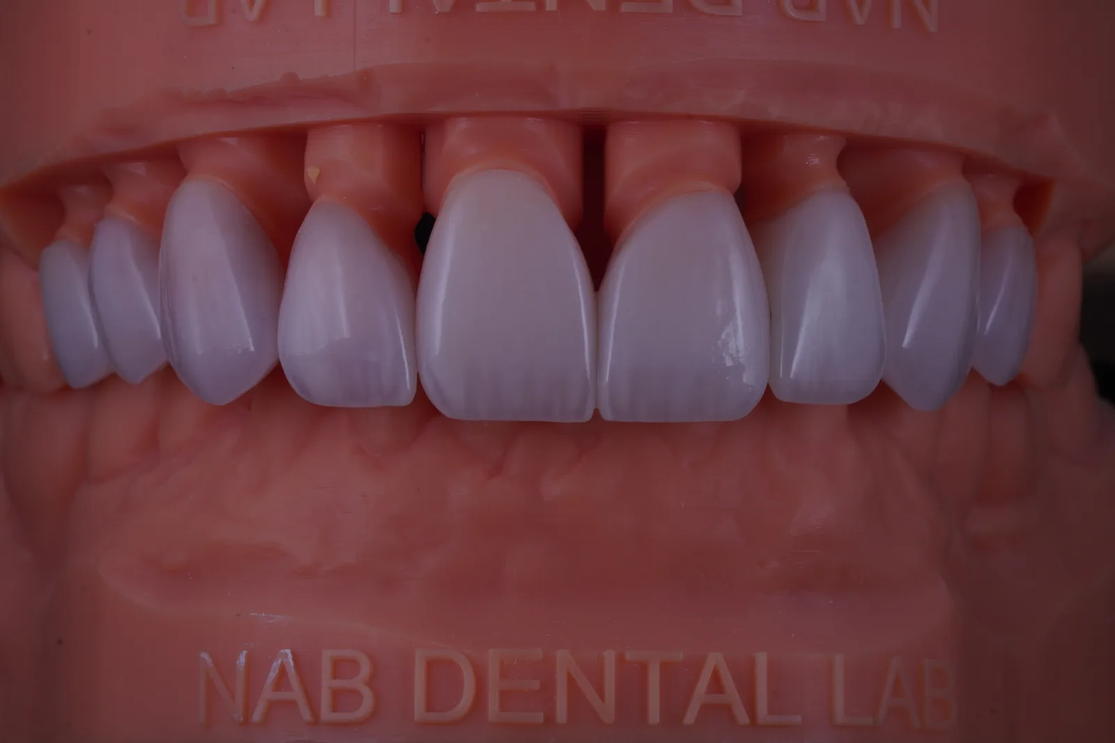 Modern Veneer — Case 3 photo 3