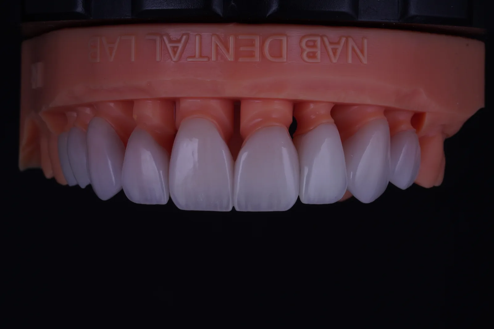 Modern Veneer — Case 3 photo 1