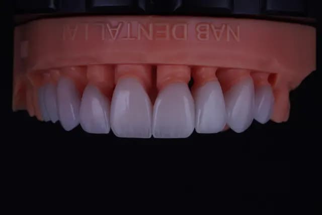 Modern Veneer — Case 3