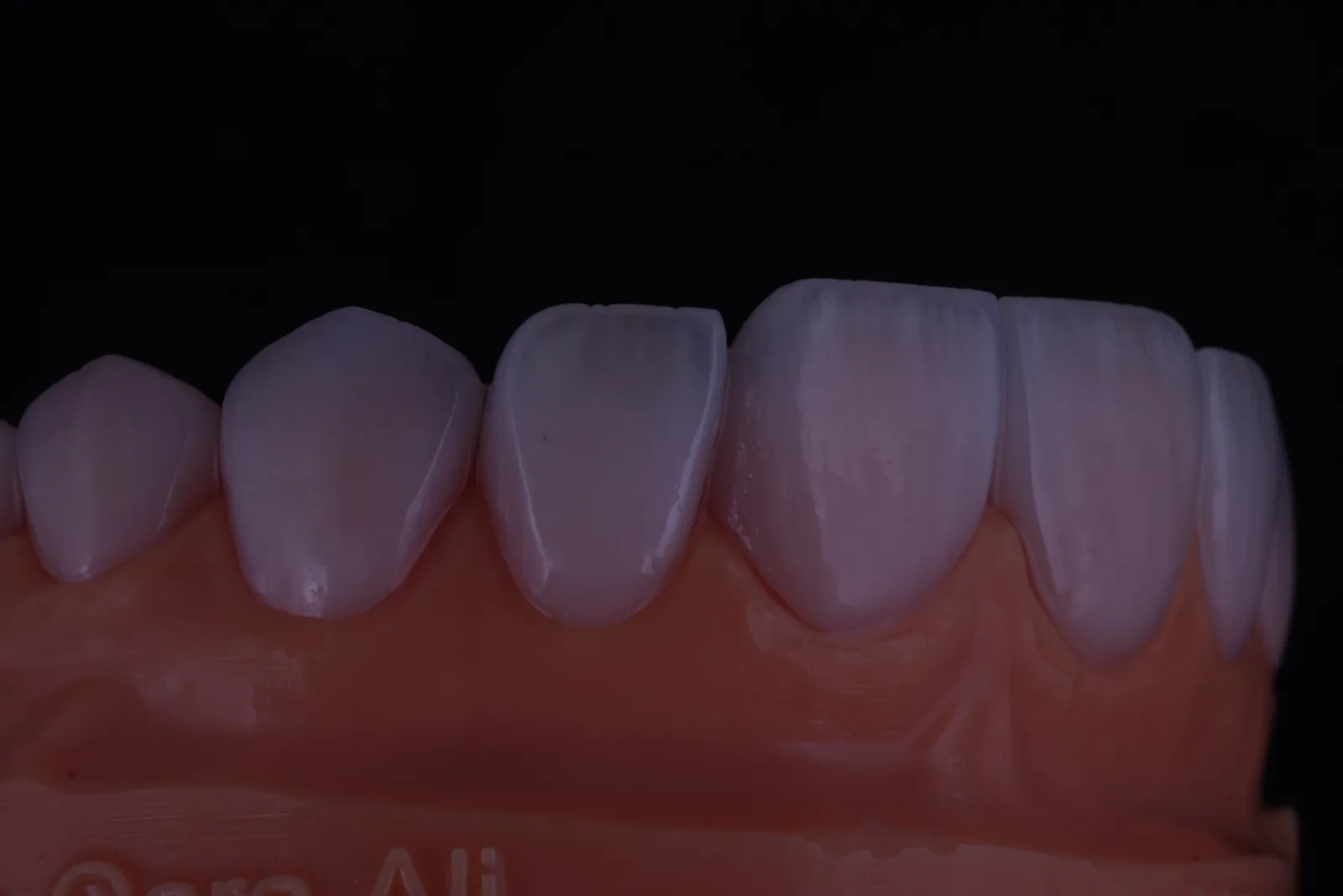 Modern Veneer — Case 4 photo 2