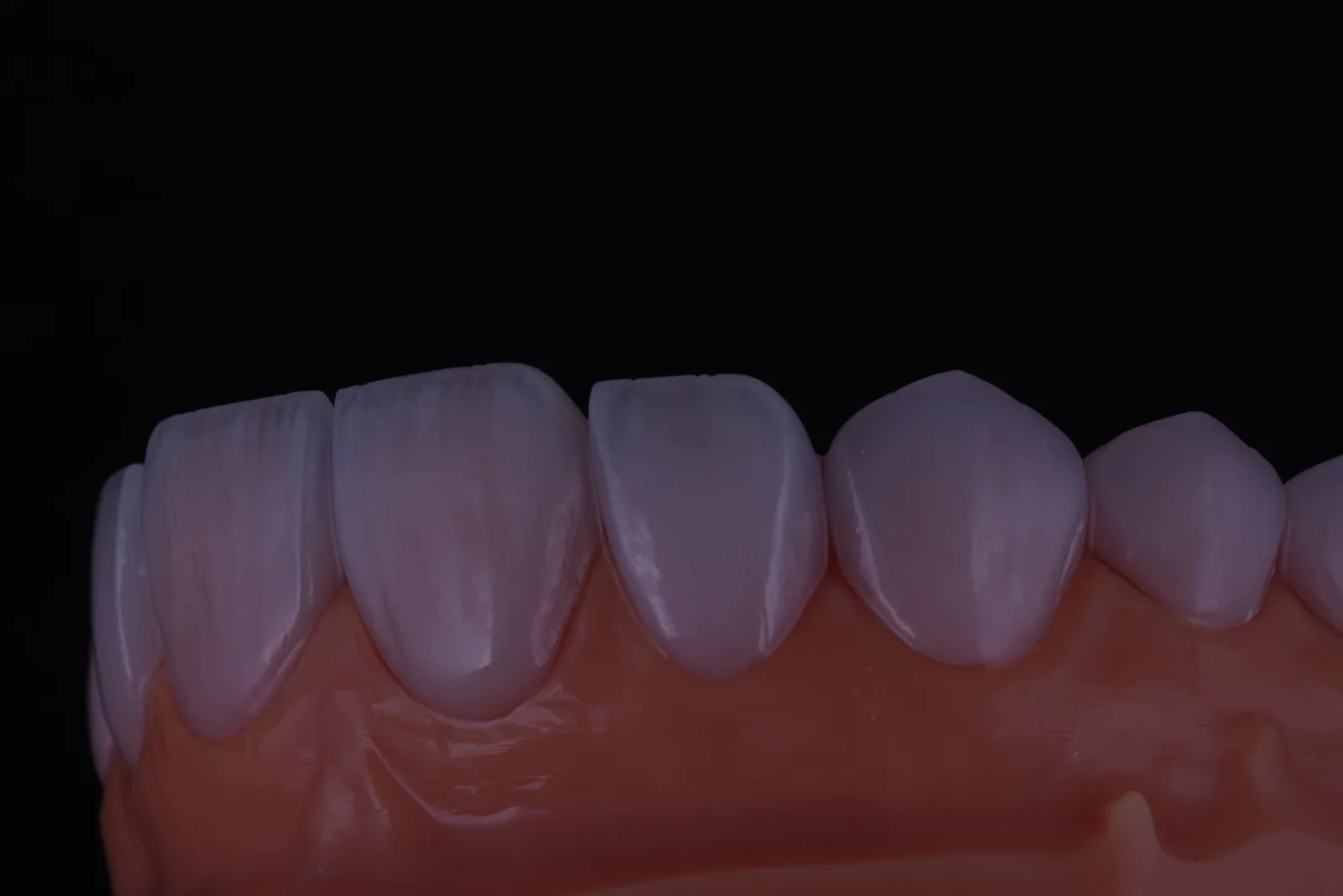 Modern Veneer — Case 4 photo 3