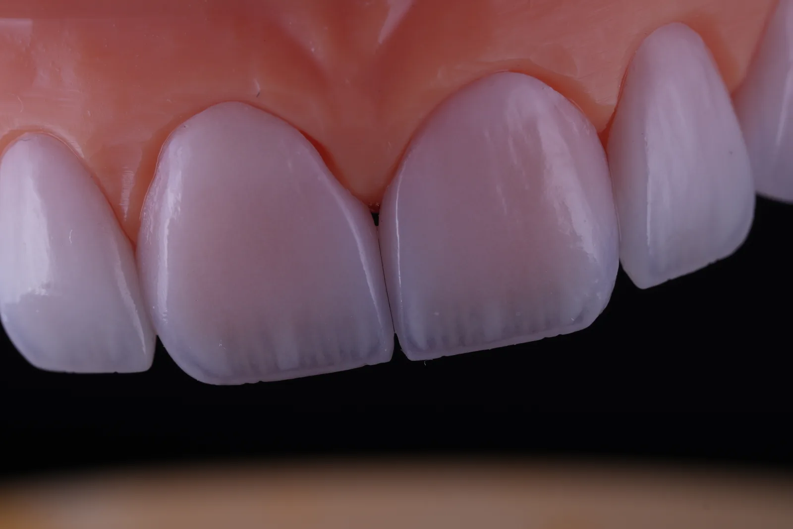Modern Veneer — Case 4 photo 4