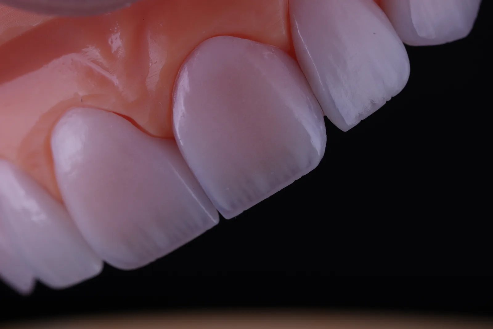 Modern Veneer — Case 4 photo 5