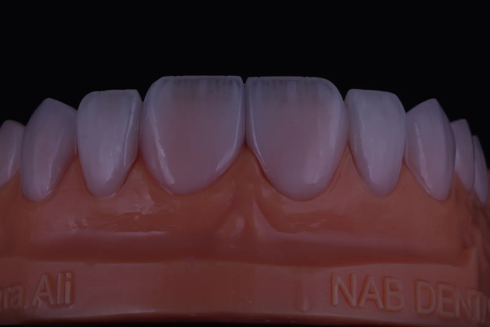 Modern Veneer — Case 4 photo 1