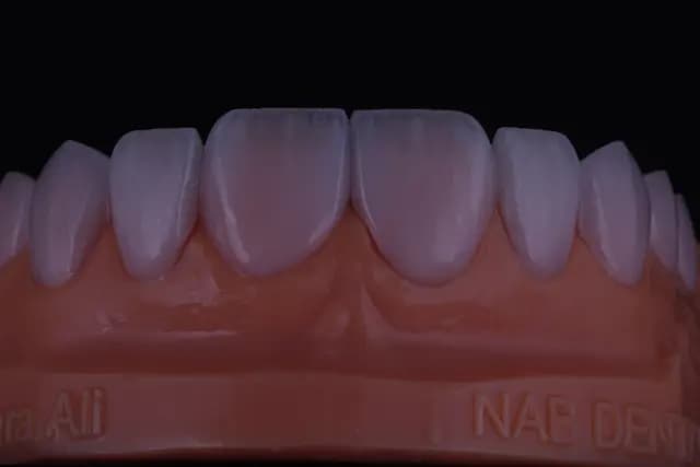 Modern Veneer — Case 4