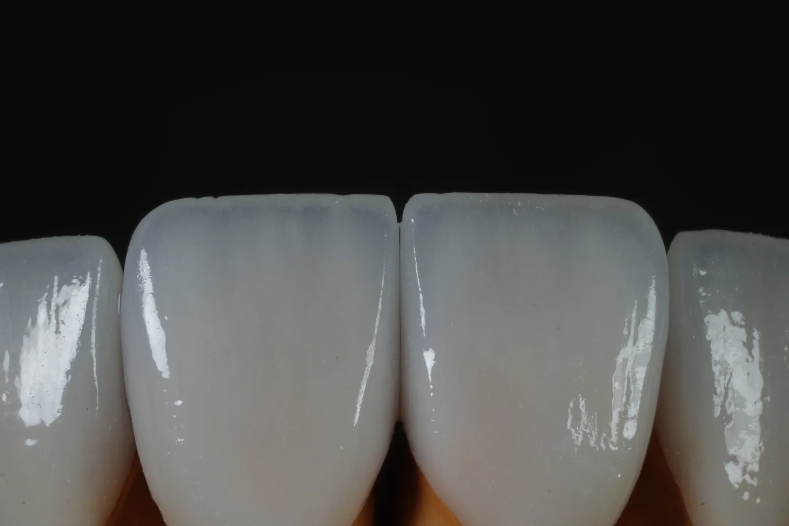 Emax Veneer — Case 1 photo 2