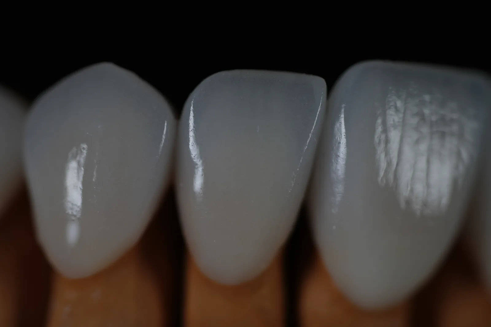 Emax Veneer — Case 1 photo 3