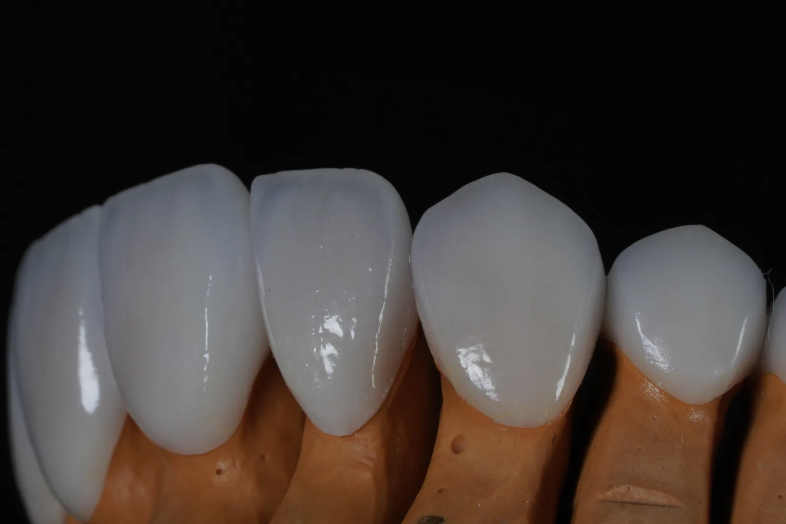 Emax Veneer — Case 1 photo 4