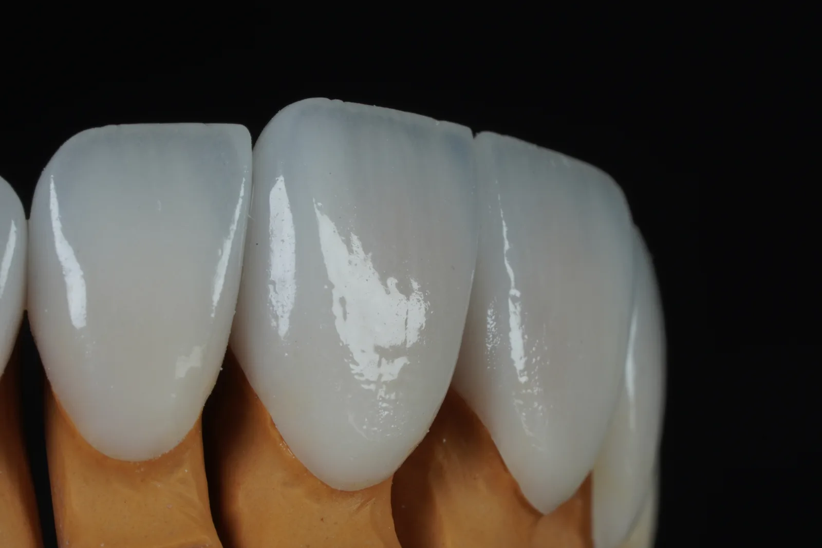 Emax Veneer — Case 1 photo 5