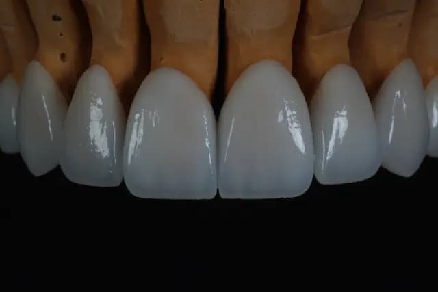 Emax Veneer — Case 1